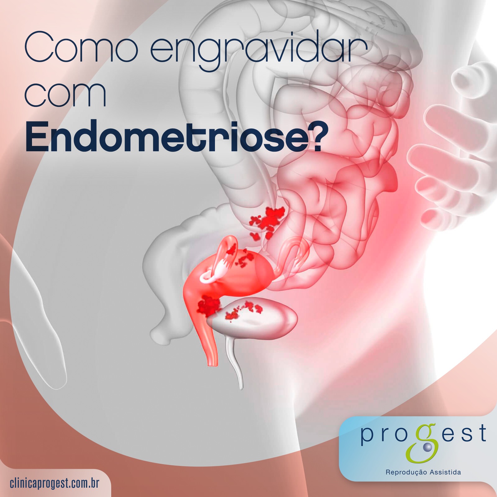 Como engravidar com endometriose?