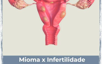 Mioma x Infertilidade