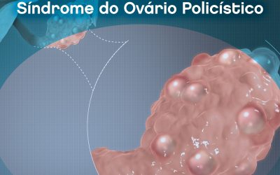 A Síndrome do Ovário Policístico (SOP) é uma doença que afeta 8 a 13% das mulheres