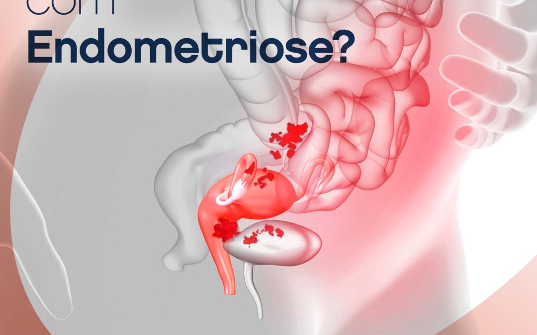 Como engravidar com endometriose?